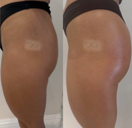 Non-Surgical BBL Non-Surgical BBL