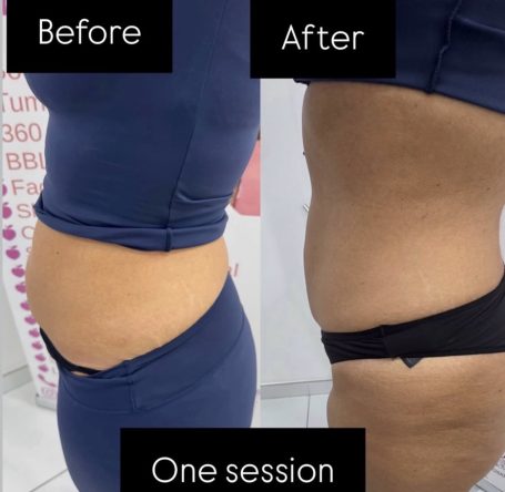 Non-Surgical Tummy Tuck Non-Surgical Tummy Tuck
