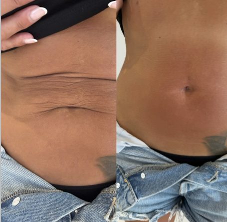 Skin Tightening Skin Tightening