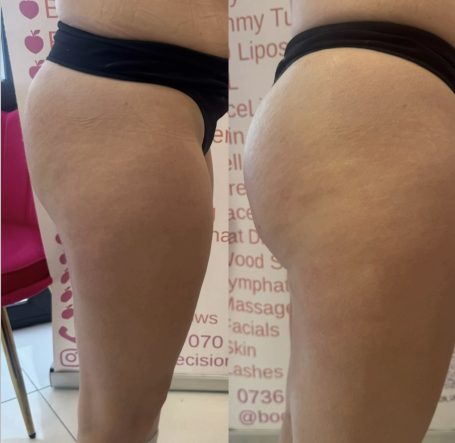Non-Surgical BBL Non-Surgical BBL