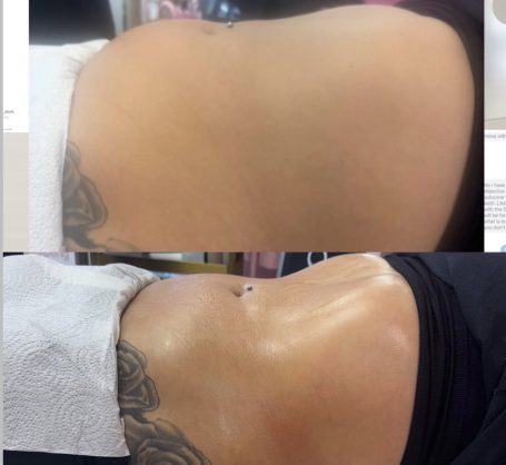 Non-Surgical Tummy Tuck Non-Surgical Tummy Tuck