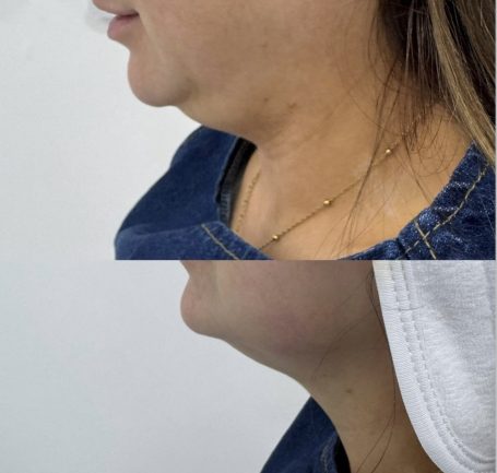 Non Surgical Brazilian Face Lift Non Surgical Brazilian Face Lift