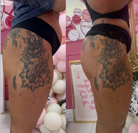 Non-Surgical BBL & Tummy Tuck Non-Surgical BBL & Tummy Tuck