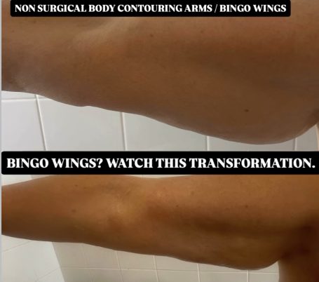 Non Surgical Bingo Wings Non Surgical Bingo Wings